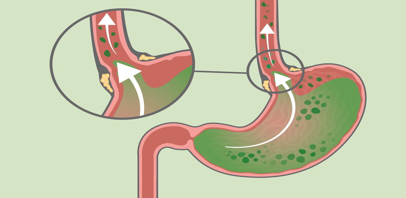 Gambar Titik Bekam Asam Lambung - Perumperindo.co.id