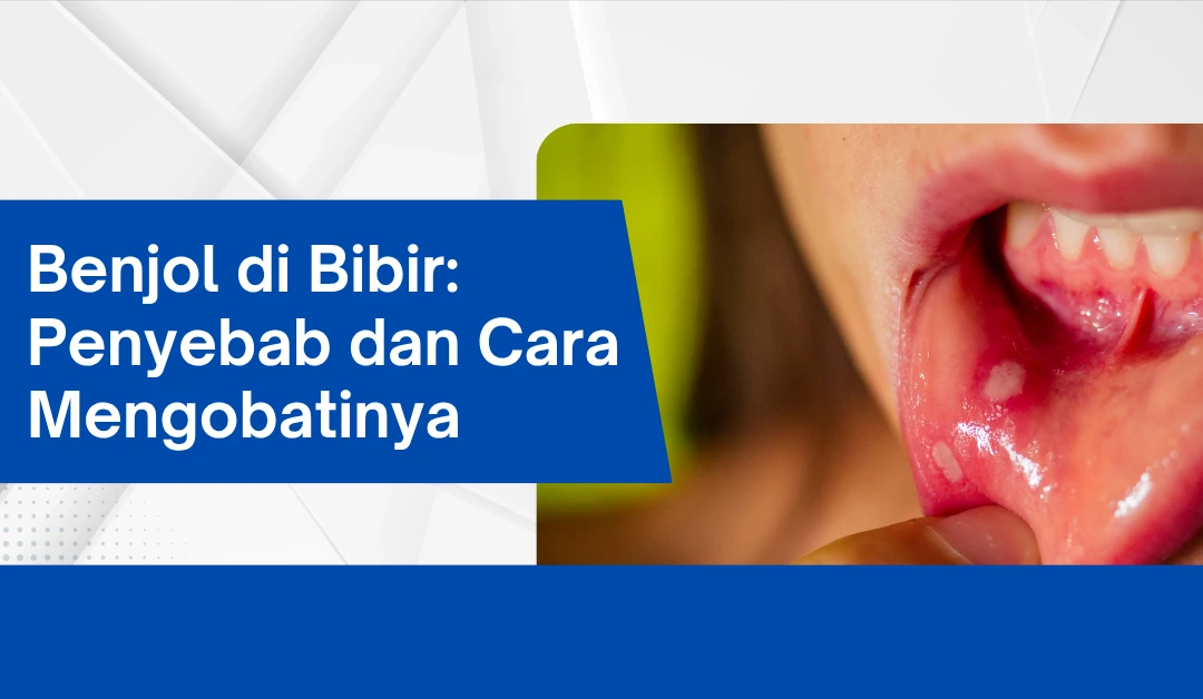 Benjol di Bibir: Penyebab dan Cara Mengobatinya